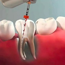 Kada reikalingas endodontinis gydymas?